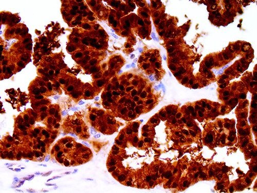 IHC of S100A6 on an FFPE Ovarian Carcinoma Tissue